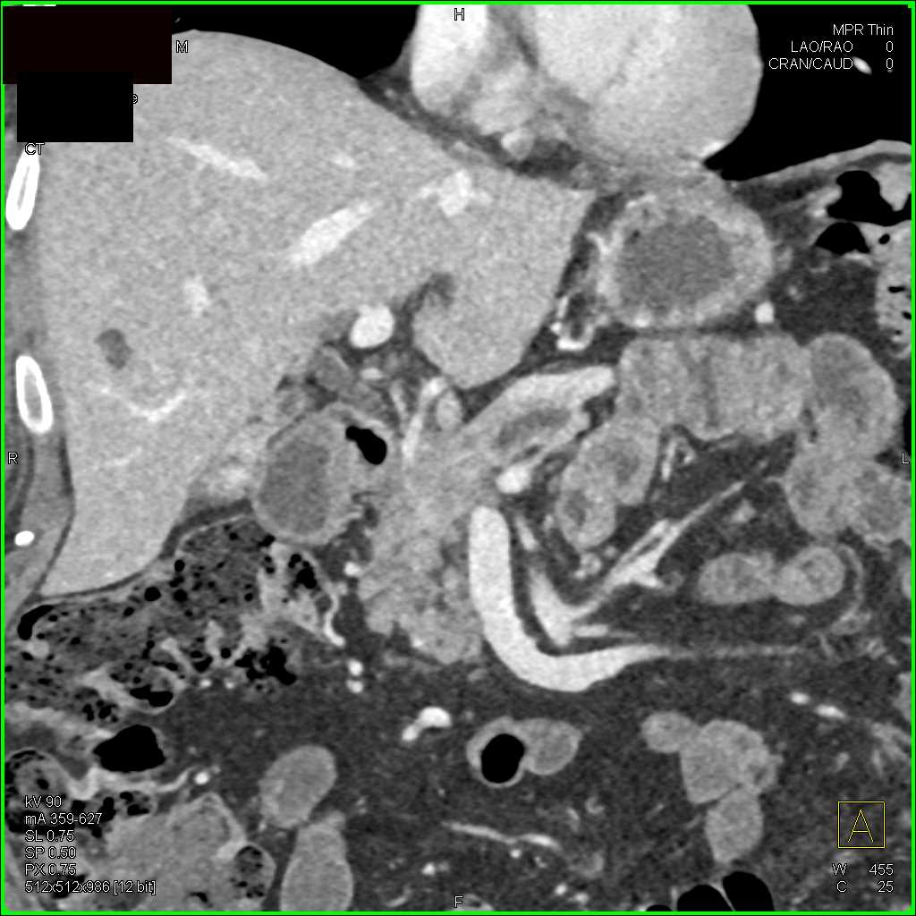 Infiltrating Pancreatic Cancer - CTisus CT Scan