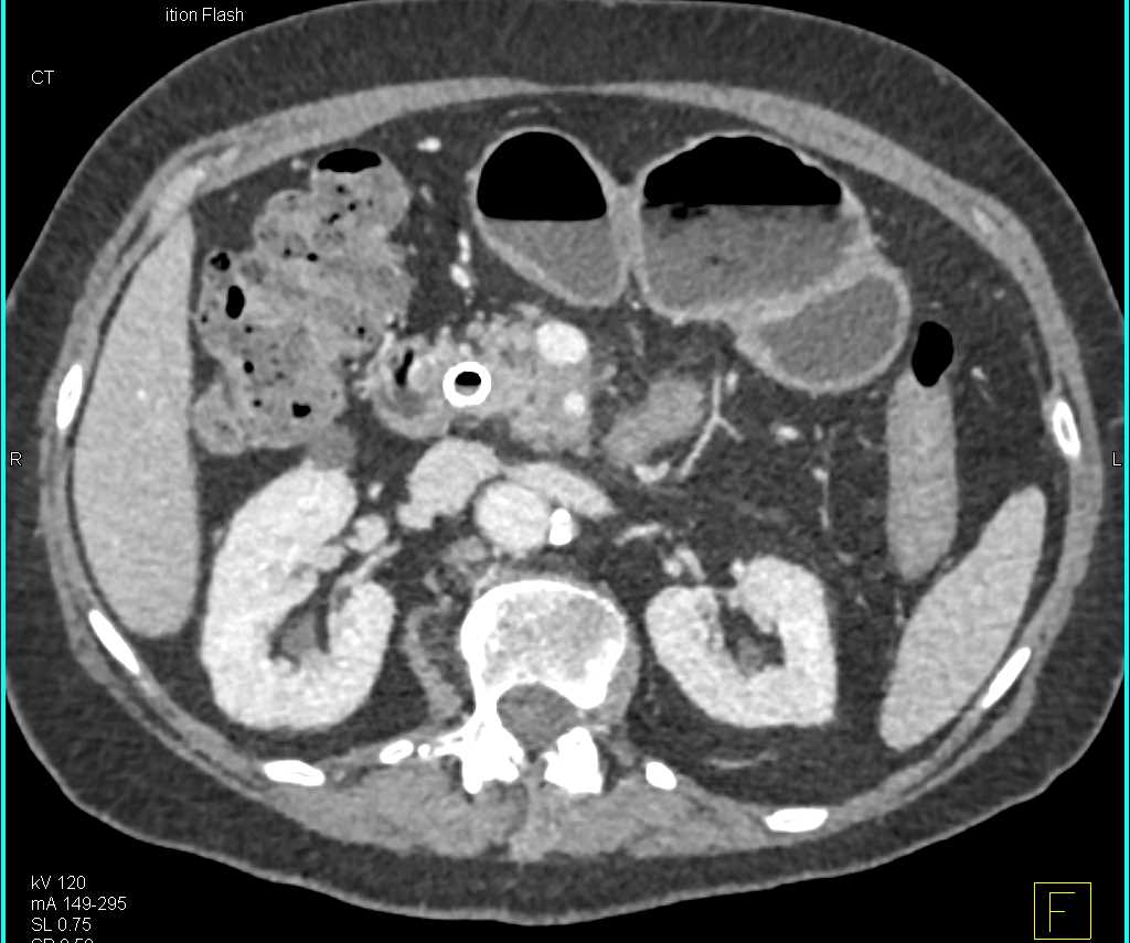 Neuroendocrine Tumor in the Head of the Pancreas - CTisus CT Scan
