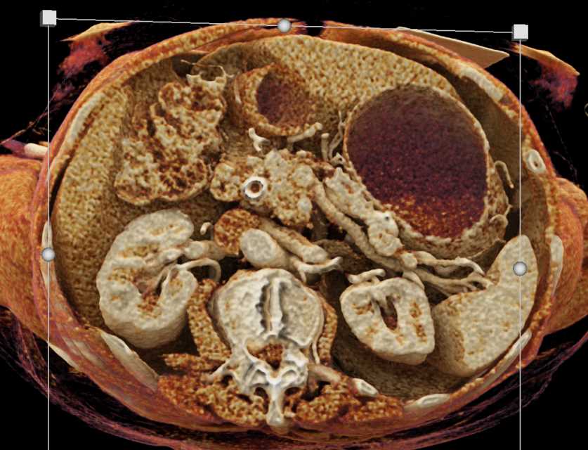 Pancreatic Neuroendocrine Tumor (PNET) Head of Pancreas with Cinematic Rendering - CTisus CT Scan