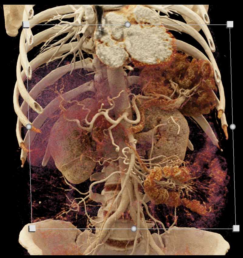 Pancreatic Cancer - CTisus CT Scan
