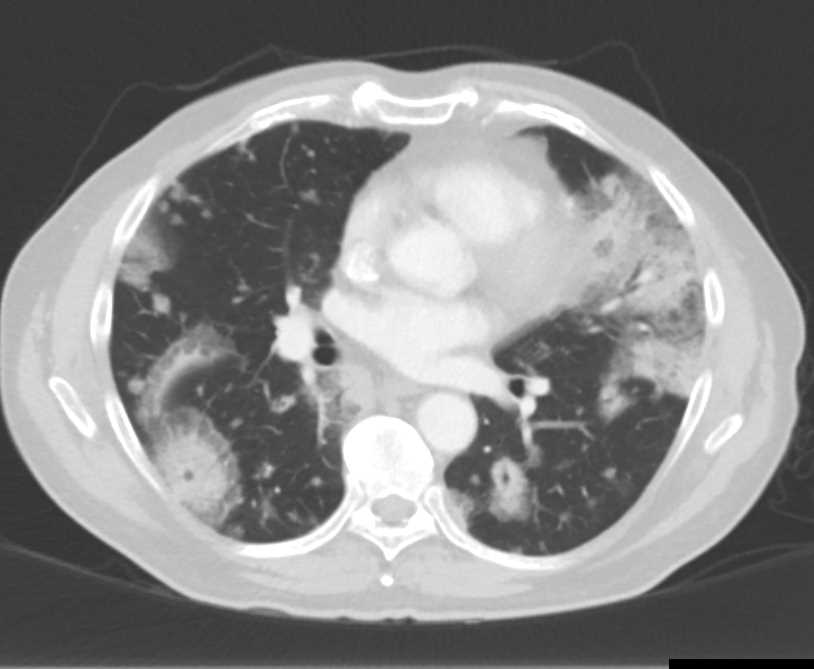 COVID Pneumonia and Pancreatic Cancer - CTisus CT Scan
