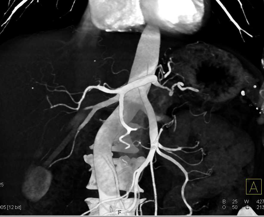 Carcinoma Tail of Pancreas with Vascular Infiltration - CTisus CT Scan