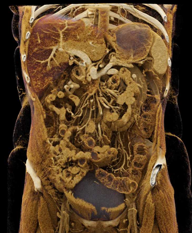 Pancreatic Cancer Encases the Superior Mesenteric Vein (SMV) with Cinematic Rendering - CTisus CT Scan