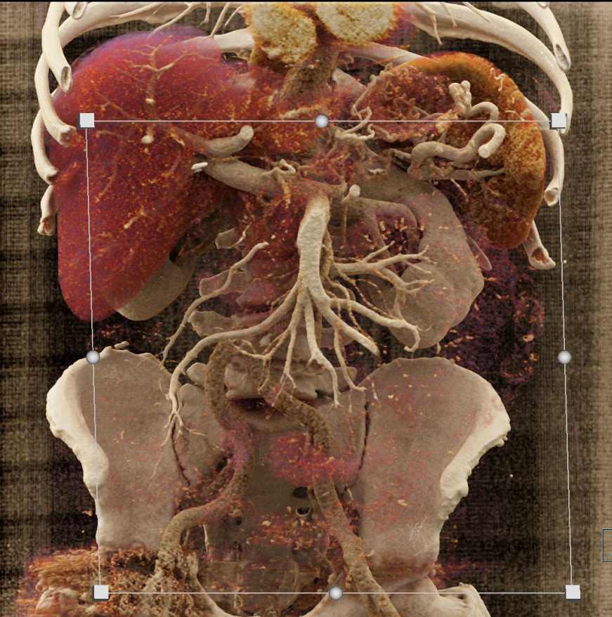Carcinoma Tail of Pancreas with Vascular Involvement - CTisus CT Scan