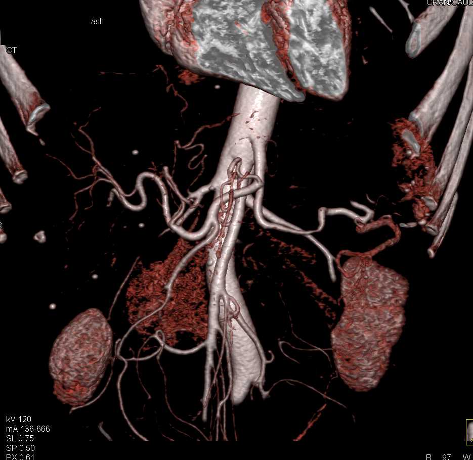 Carcinoma Body of Pancreas Obstructs the Pancreatic Duct - CTisus CT Scan