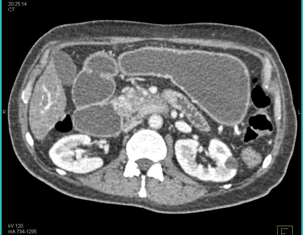 Invasive Pancreatic Cancer - CTisus CT Scan