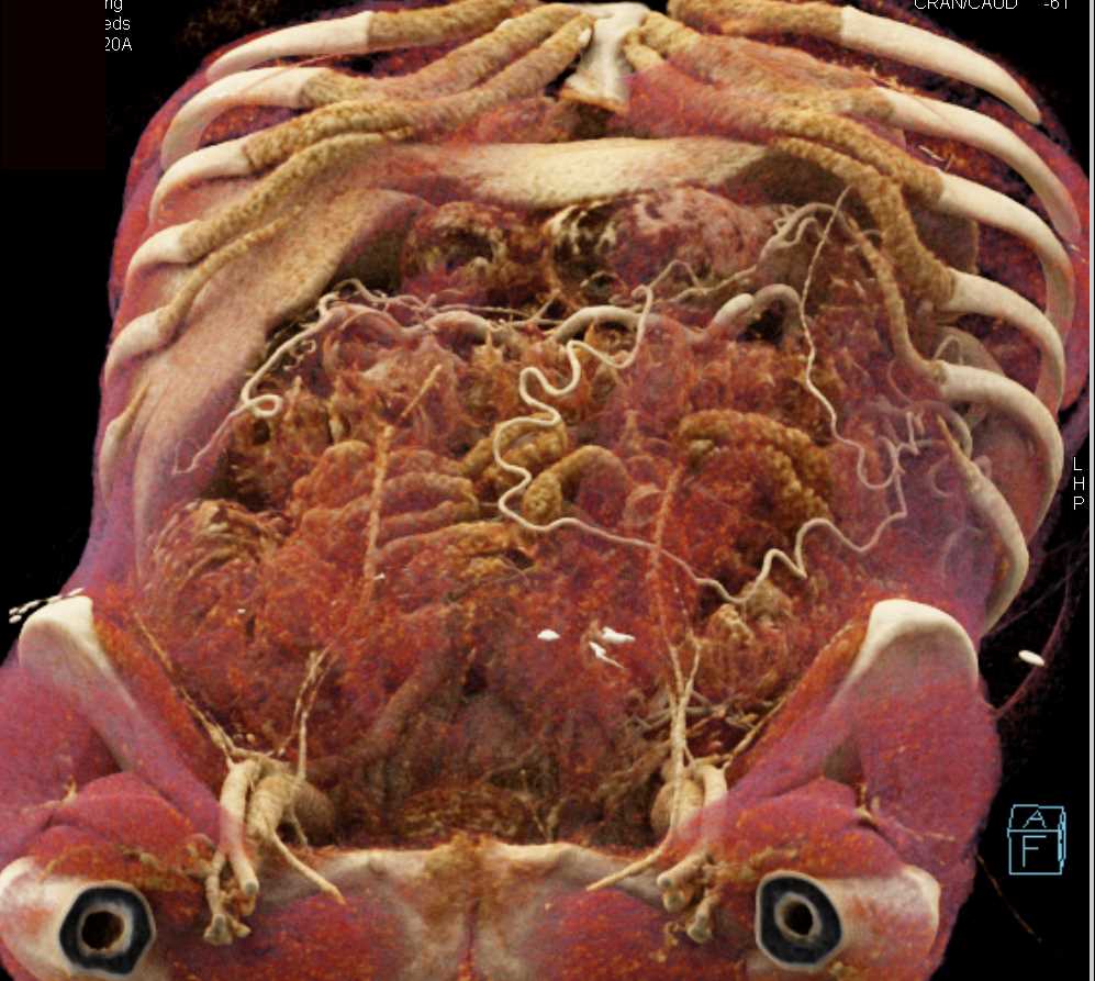 Pancreas Cancer with Cinematic Rendering - CTisus CT Scan