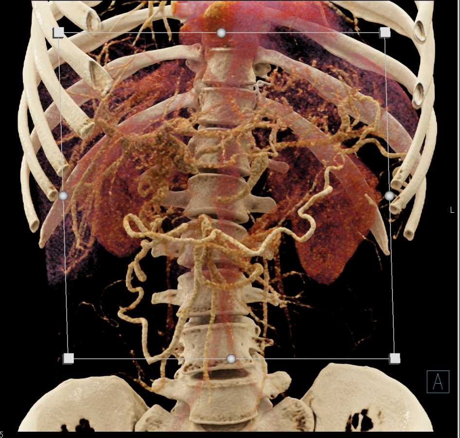 Pancreas Cancer with Cinematic Rendering - CTisus CT Scan