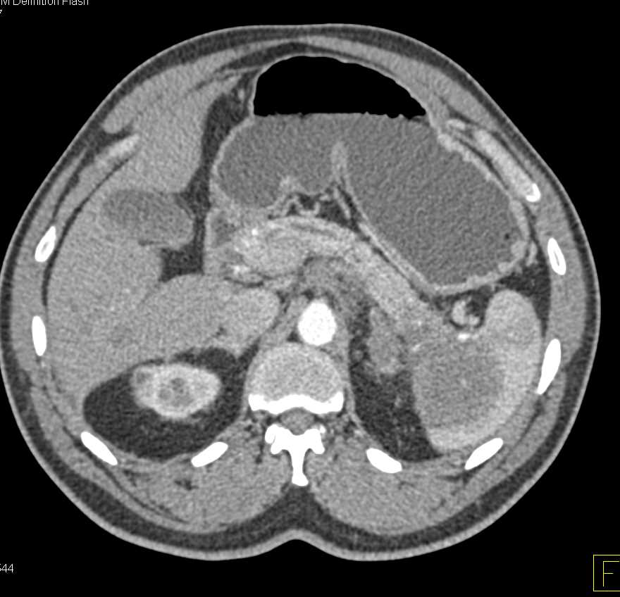 Carcinoma Tail of Pancreas with Carcinomatosis - CTisus CT Scan