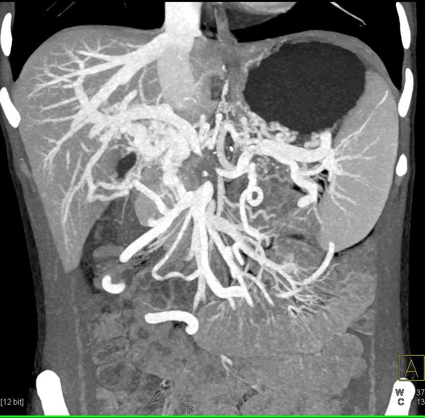 Pancreatic Adenocarcinoma with PV/SMV Occlusion - CTisus CT Scan
