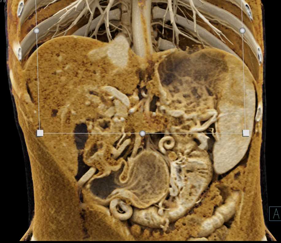 Pancreatic Adenocarcinoma with PV/SMV Occlusion Using Cinematic Rendering - CTisus CT Scan