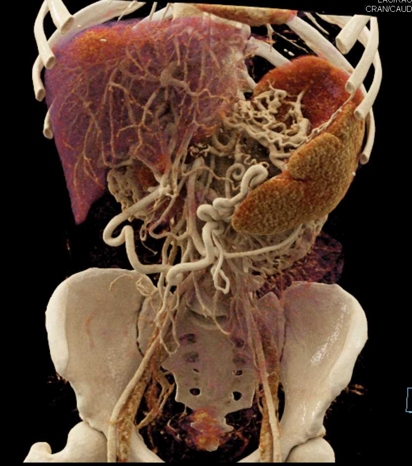 Pancreatic Adenocarcinoma with PV/SMV Occlusion Using Cinematic Rendering - CTisus CT Scan