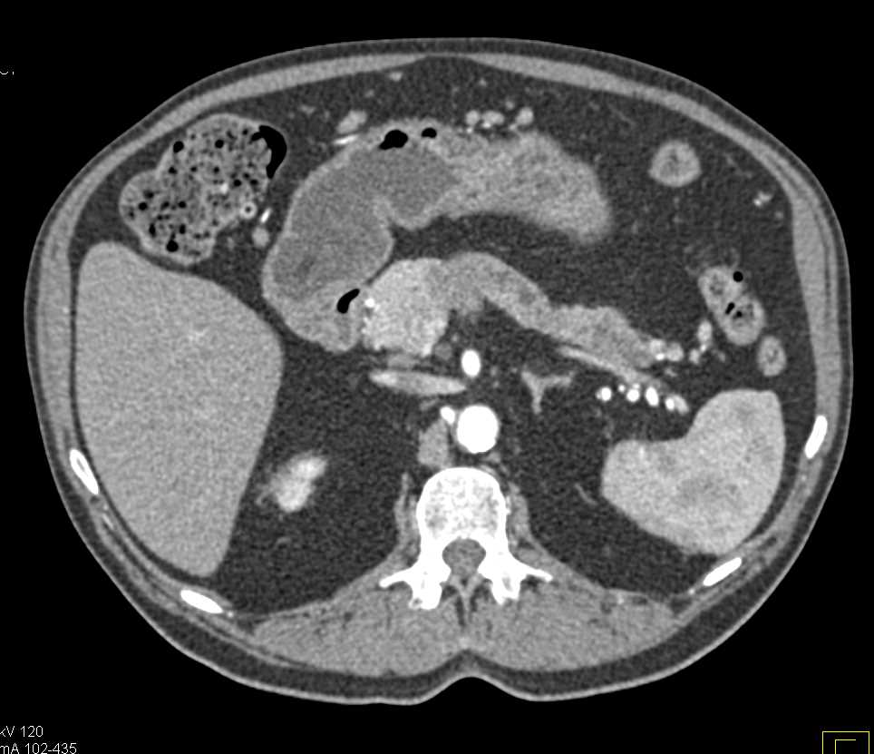 Adenocarcinoma of the Pancreas - CTisus CT Scan