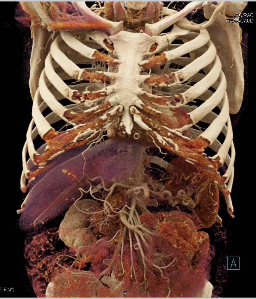 Carcinoma of the Body of the Pancreas - CTisus CT Scan