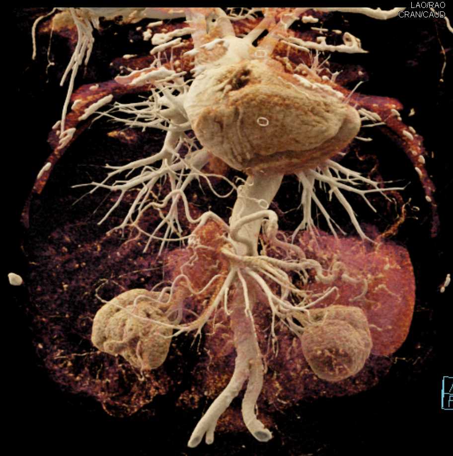 Carcinoma of the Body of the Pancreas - CTisus CT Scan