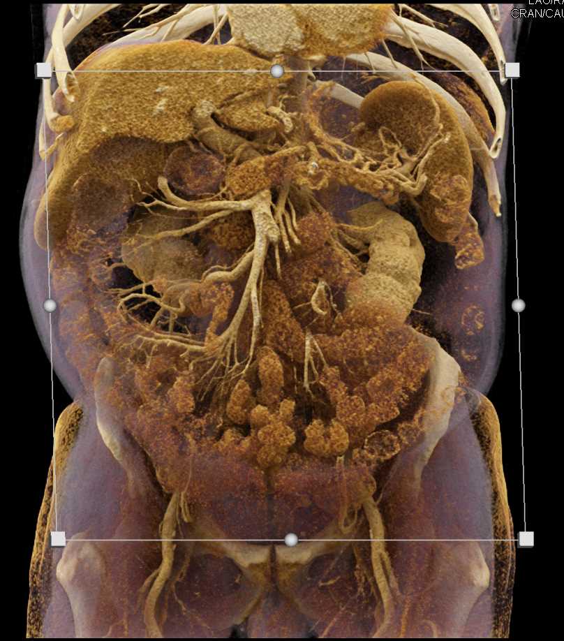 Carcinoma of the Body of the Pancreas - CTisus CT Scan