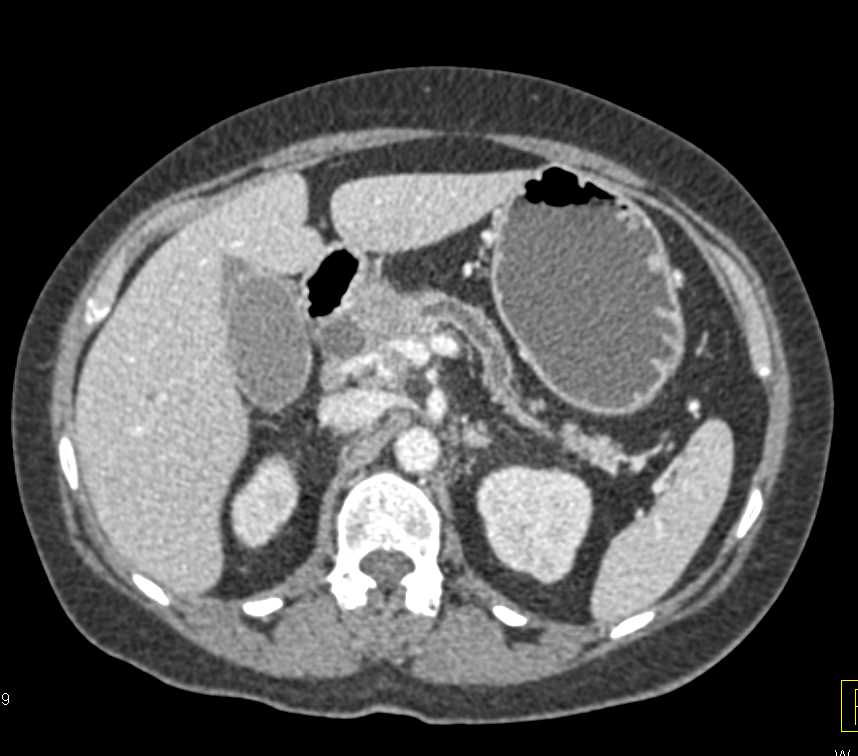Pancreatic Adenocarcinoma Obstructs the Pancreatic Duct - CTisus CT Scan