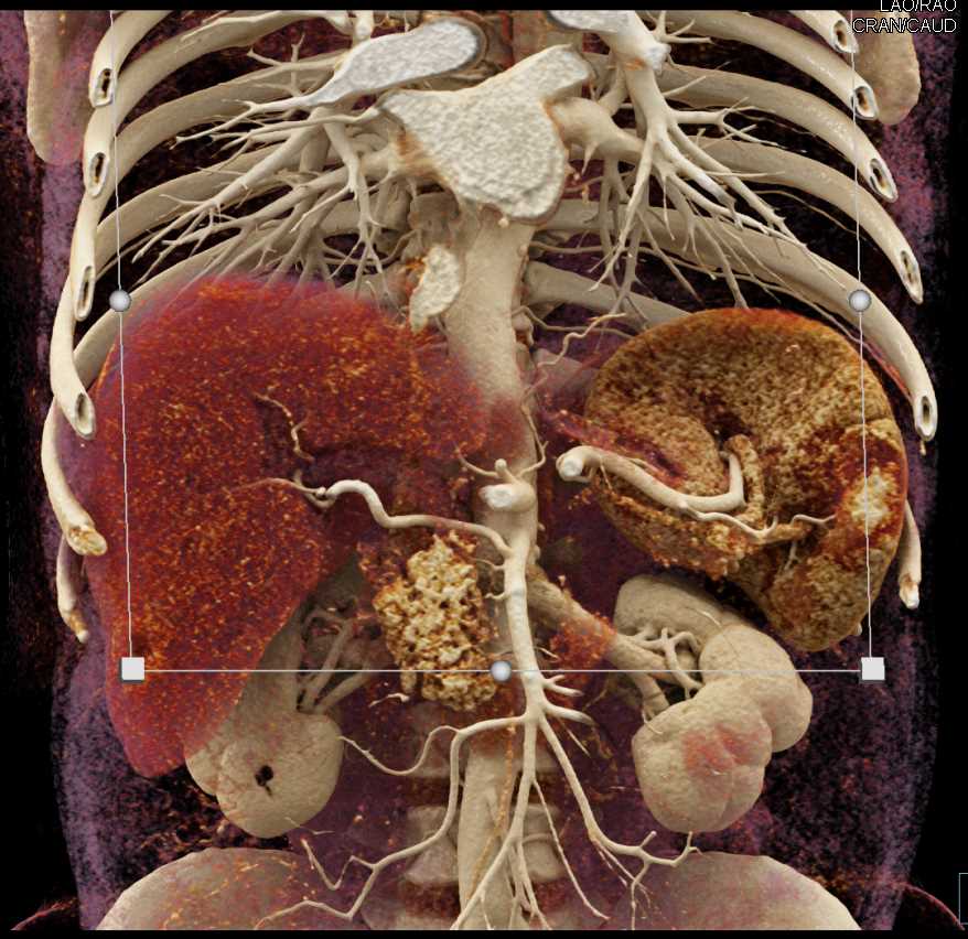 Pancreas Adenocarcinoma - CTisus CT Scan