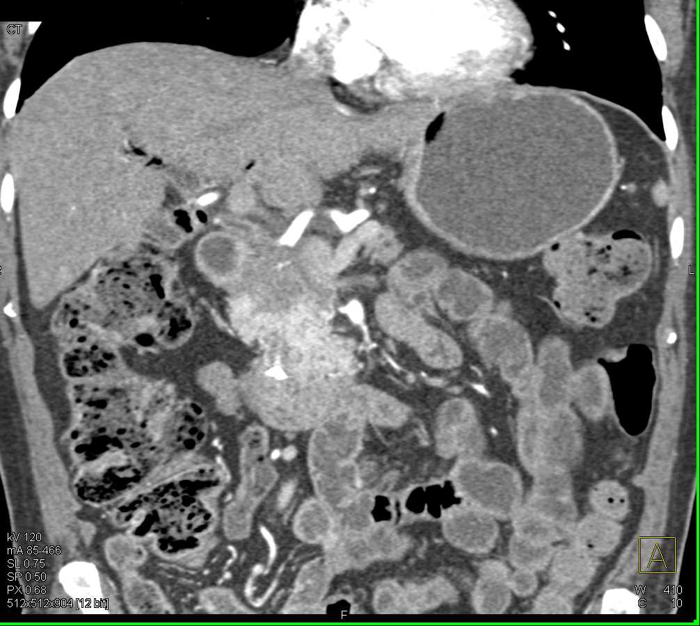 Adenocarcinoma Head of Pancreas - CTisus CT Scan