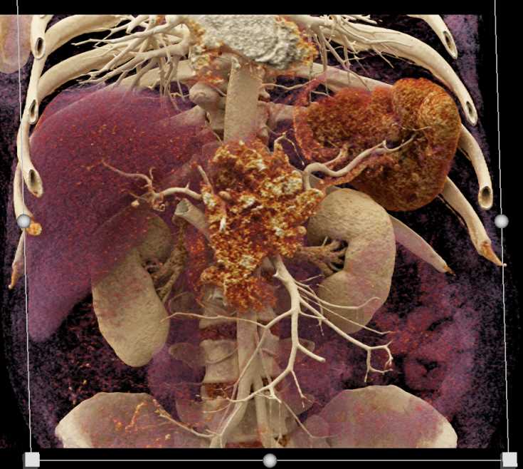 Pancreatic Adenocarcinoma - CTisus CT Scan