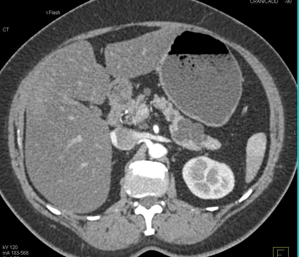 Intraductal Papillary Mucinous Neoplasm (IPMN) Tail of Pancreas and Incidental Right Renal Angiomyolipoma (AML) - CTisus CT Scan