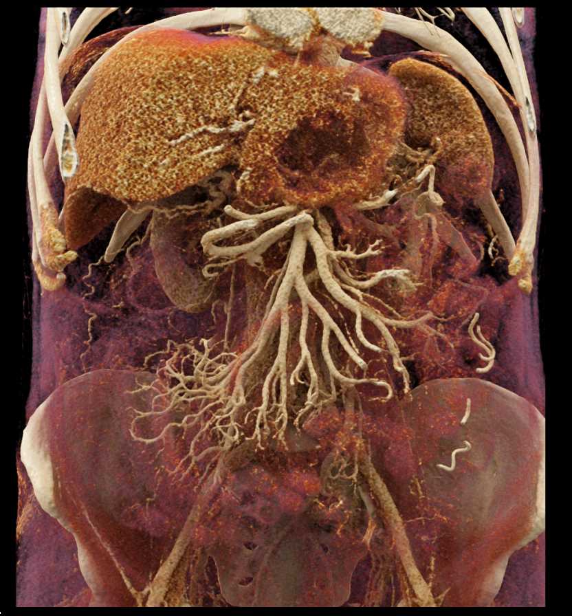 Pancreatic Cancer Encases the Celiac Artery - CTisus CT Scan