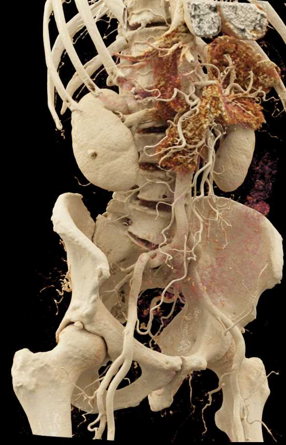 Carcinoma of the Pancreas - CTisus CT Scan