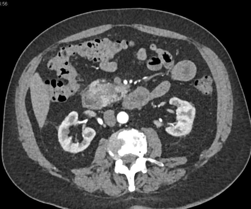 Adenocarcinoma of the Pancreas - CTisus CT Scan