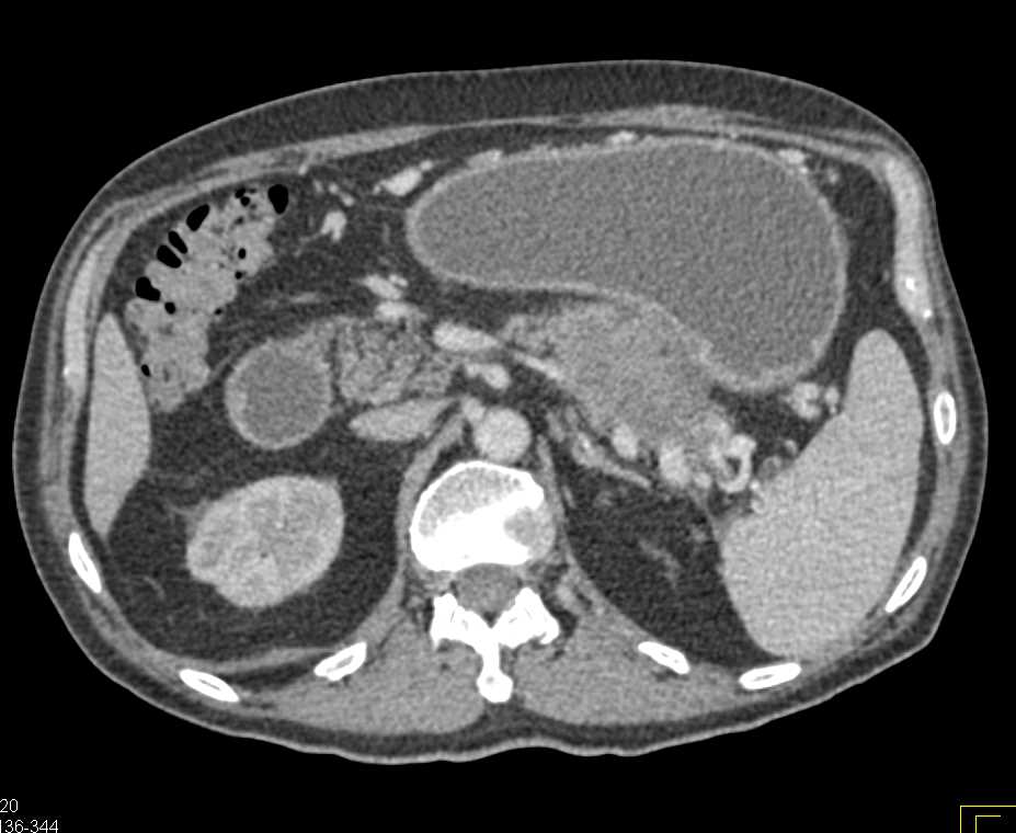 Carcinoma Tall of Pancreas Invades the Fourth Portion of the Duodenum - CTisus CT Scan