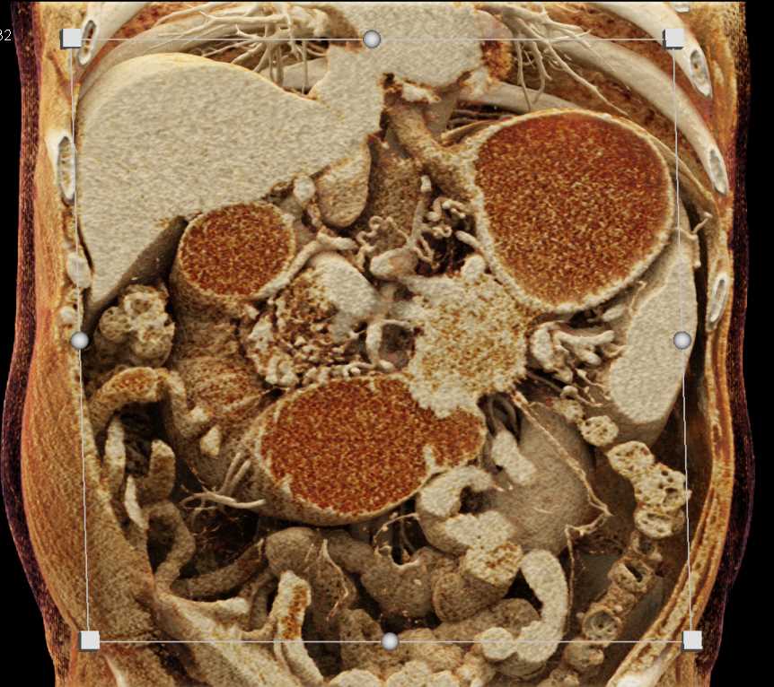 Carcinoma Tall of Pancreas Invades the Fourth Portion of the Duodenum with Cinematic Rendering - CTisus CT Scan