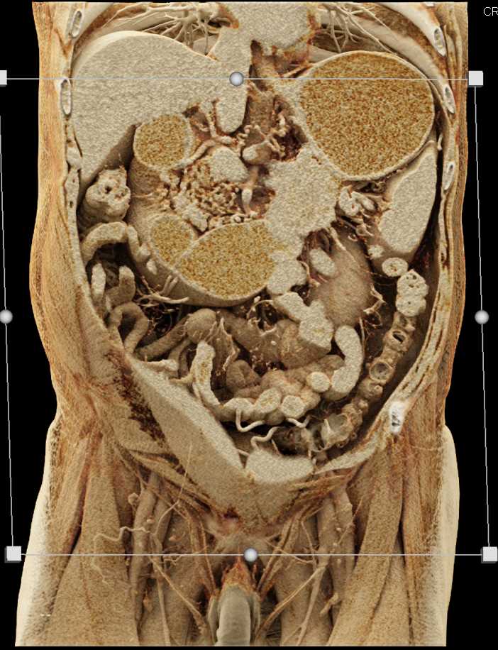 Carcinoma Tall of Pancreas Invades the Fourth Portion of the Duodenum Using Cinematic Rendering - CTisus CT Scan