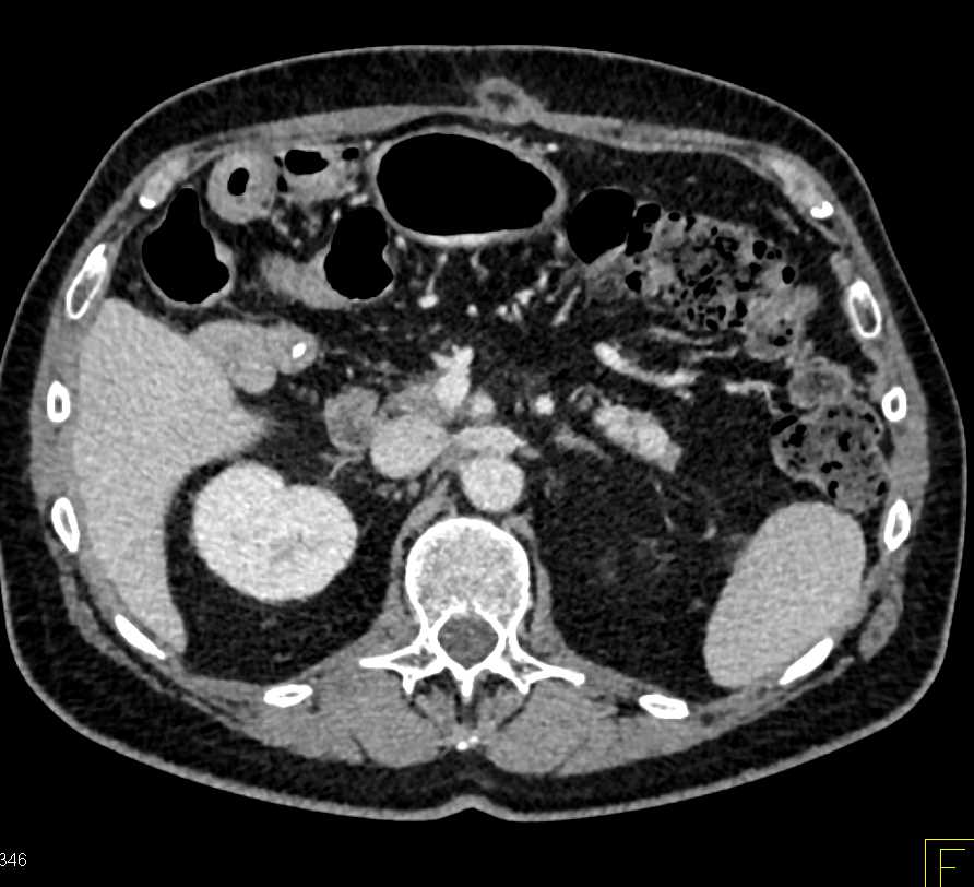 Neuroendocrine Tumor in the Tail of the Pancreas - CTisus CT Scan