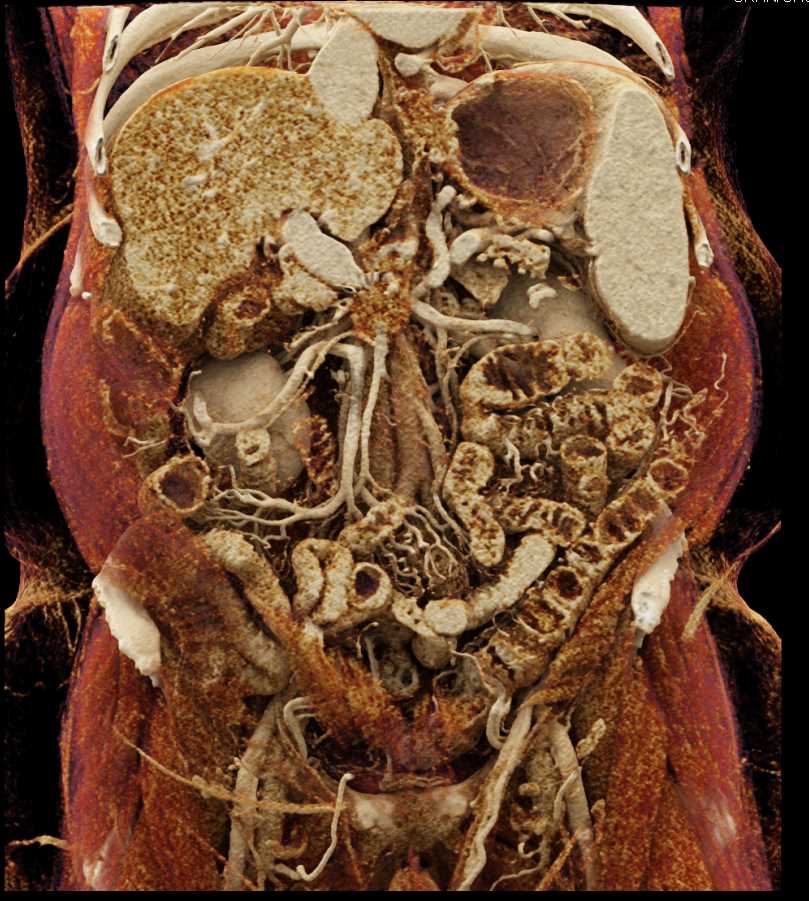 Carcinoma Head of Pancreas - CTisus CT Scan