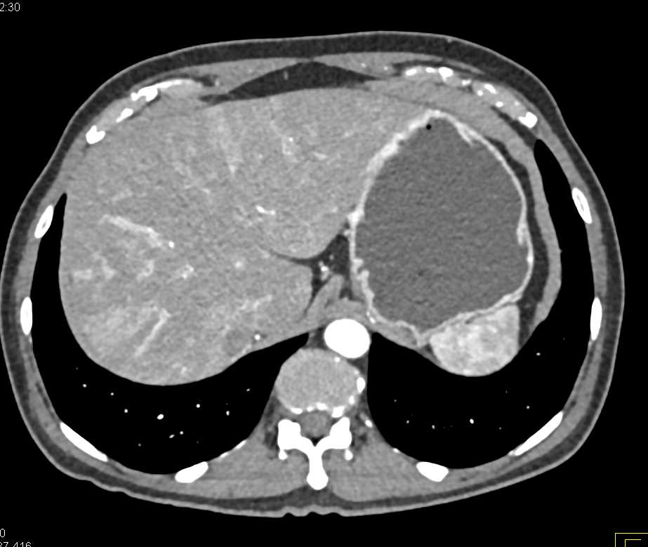 Carcinoma Head of Pancreas - CTisus CT Scan
