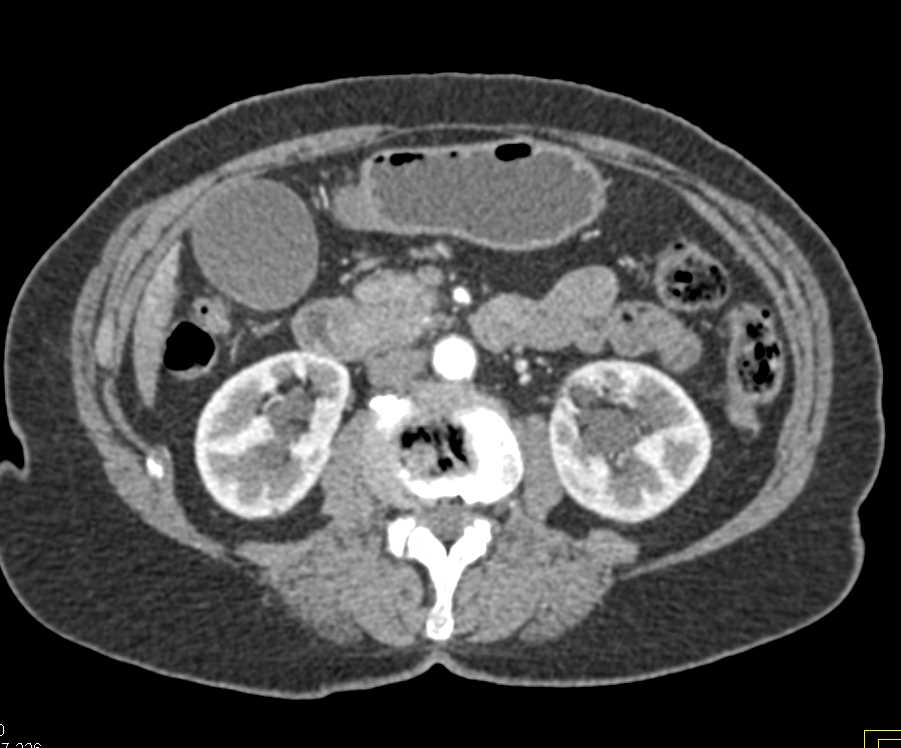 Carcinoma Head of Pancreas Obstructs the Common Bile Duct (CBD) - CTisus CT Scan