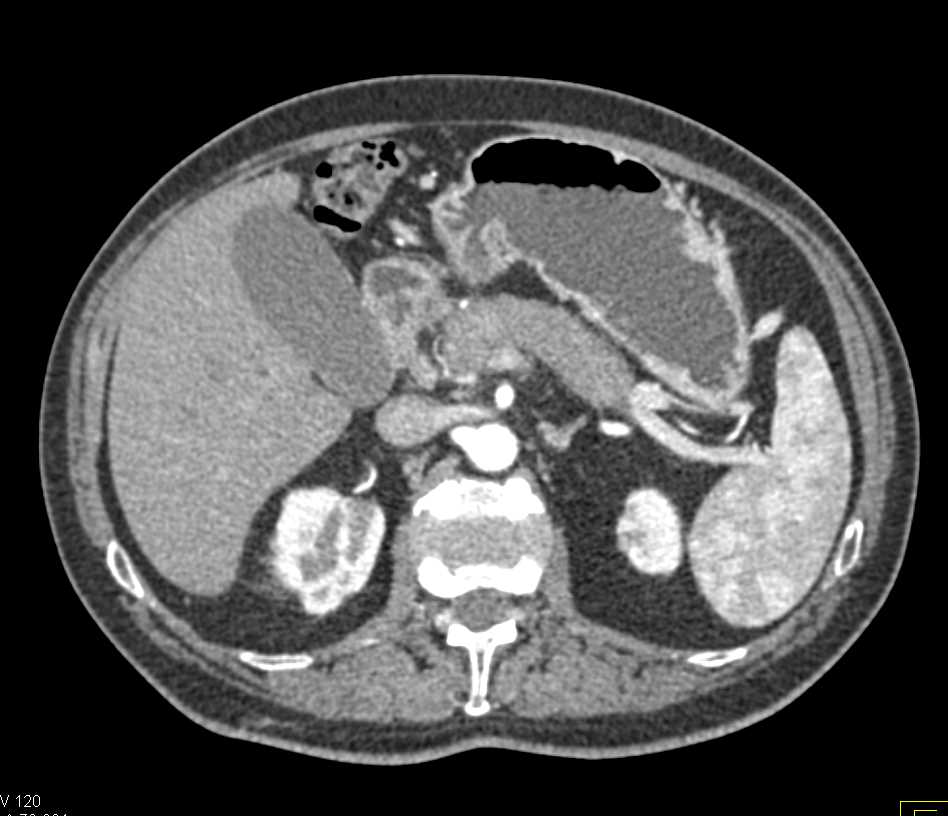 Autoimmune Pancreatitis - CTisus CT Scan