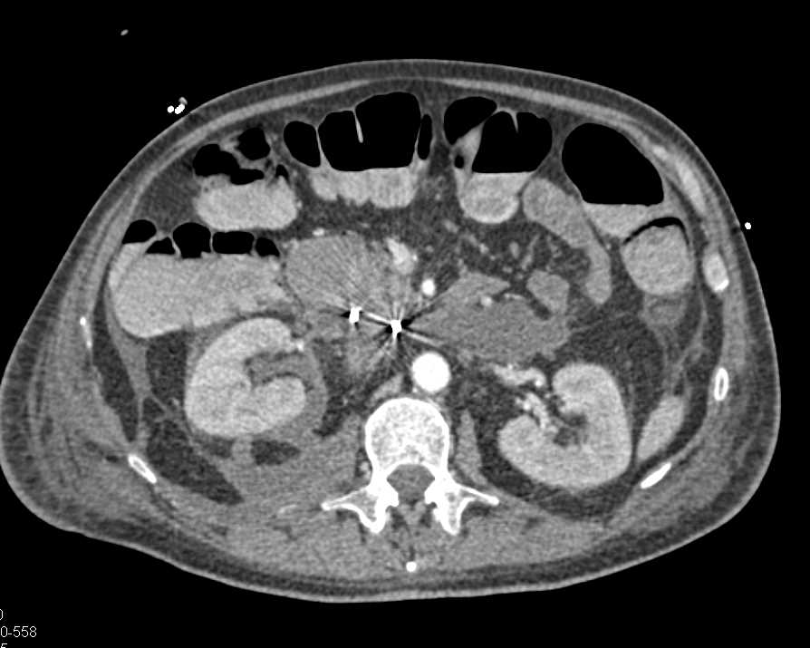 Pancreatitis with Peripancreatic Abscess - CTisus CT Scan