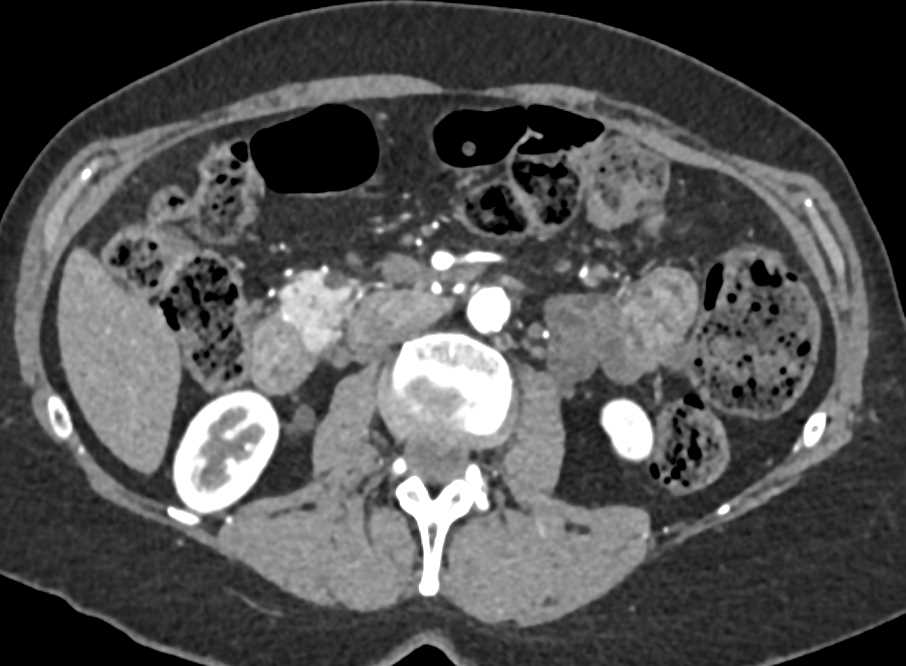 Pancreatic Enhancement - CTisus CT Scan