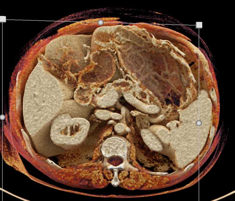 Pancreatic Cancer with Dilated Pancreatic Duct and Incidental GIST Tumor Stomach - CTisus CT Scan