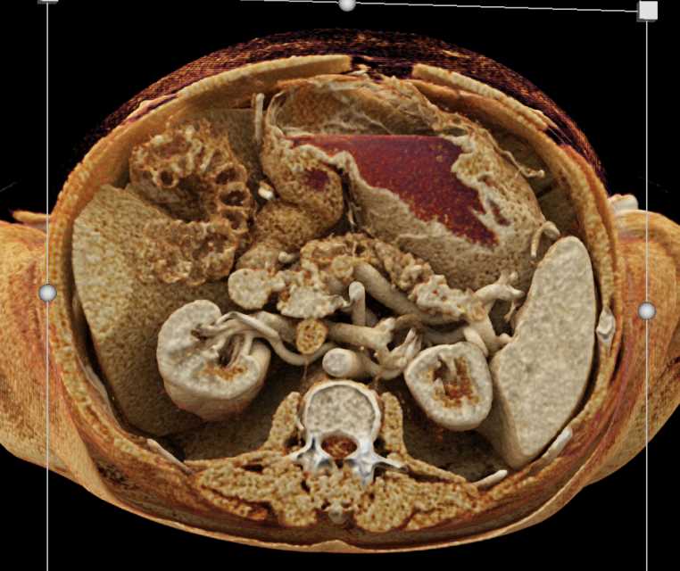 Pancreatic Cancer with Dilated Pancreatic Duct and Incidental GIST Tumor Stomach - CTisus CT Scan