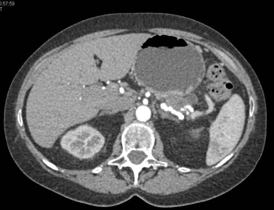 Carcinoma Tail of the Pancreas - CTisus CT Scan