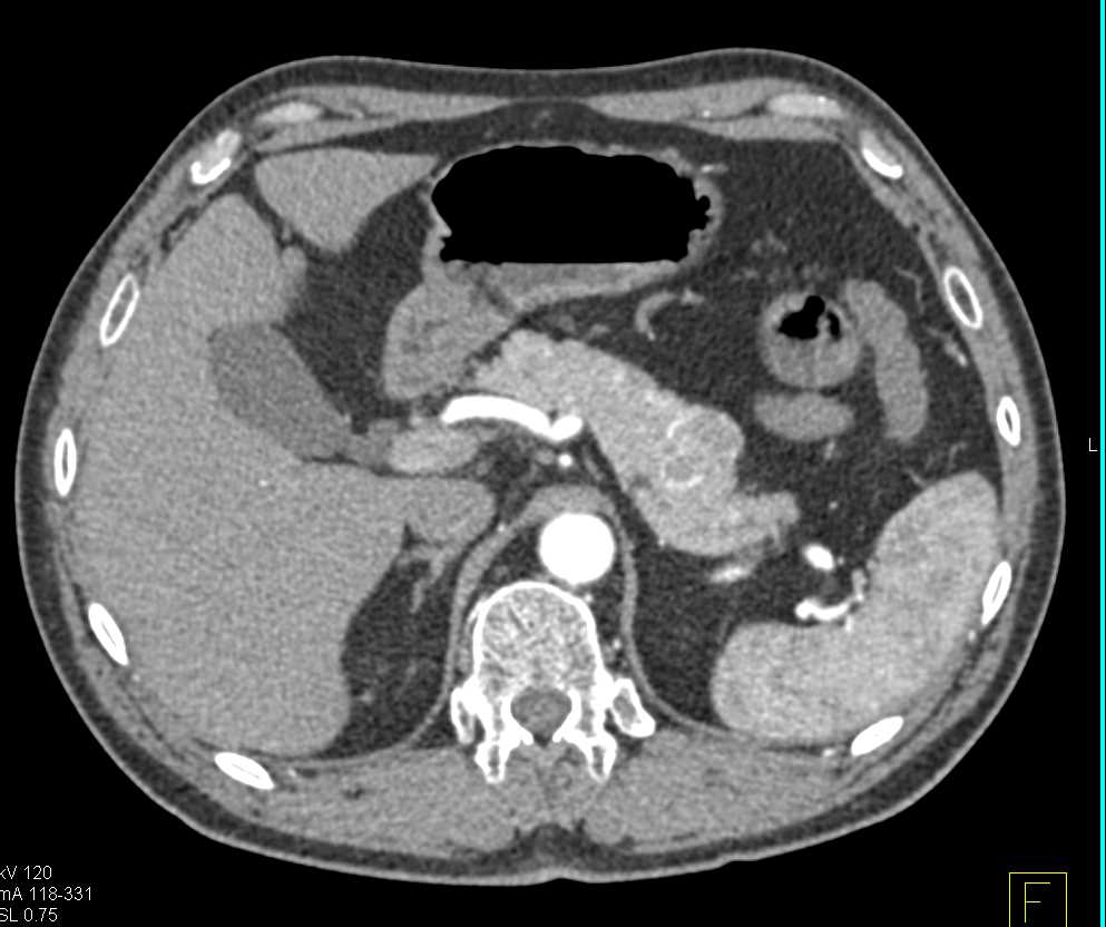 Neuroendocrine Tumor in the Tail of the Pancreas - CTisus CT Scan