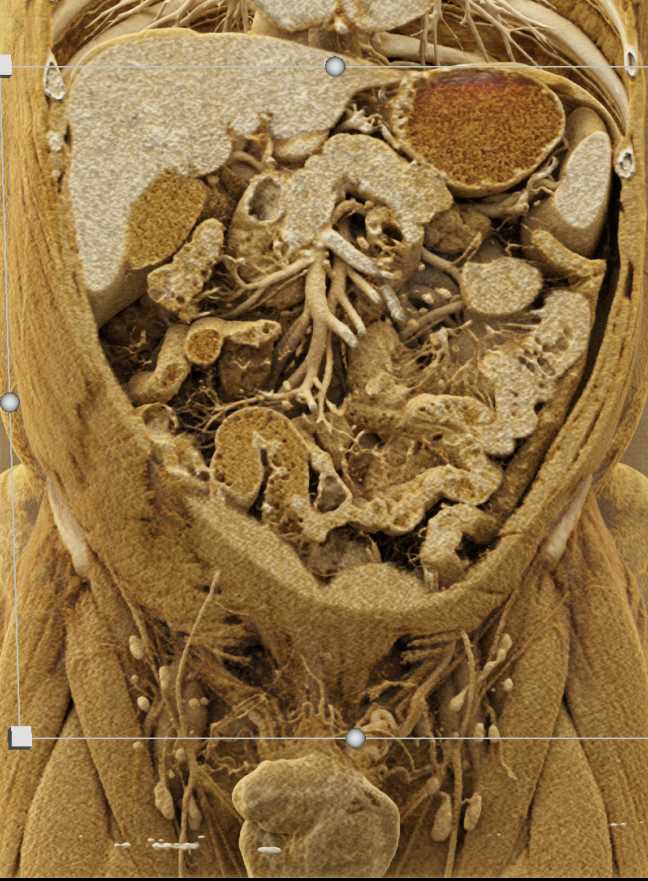 Neuroendocrine Tumor in the Tail of the Pancreas with Cinematic Rendering - CTisus CT Scan