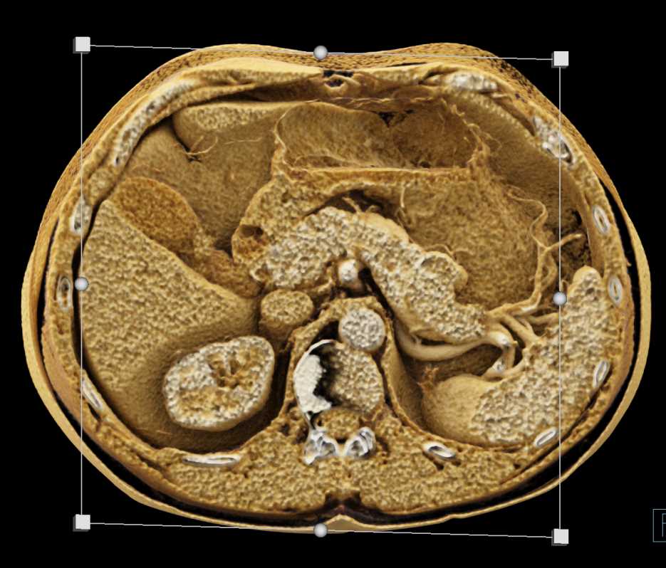 Cystic Pancreatic Cancer Tail of the Pancreas with Cinematic Rendering - CTisus CT Scan