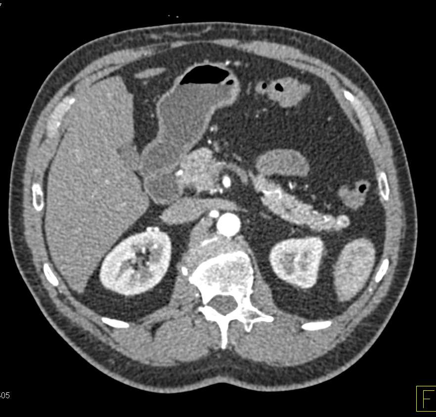 Pancreatic Neuroendocrine Tumor (PNET) Tail of Pancreas - CTisus CT Scan