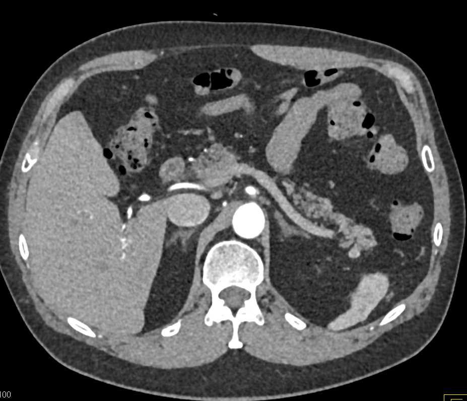 Accessory Spleen Near the Tail of the Pancreas - CTisus CT Scan