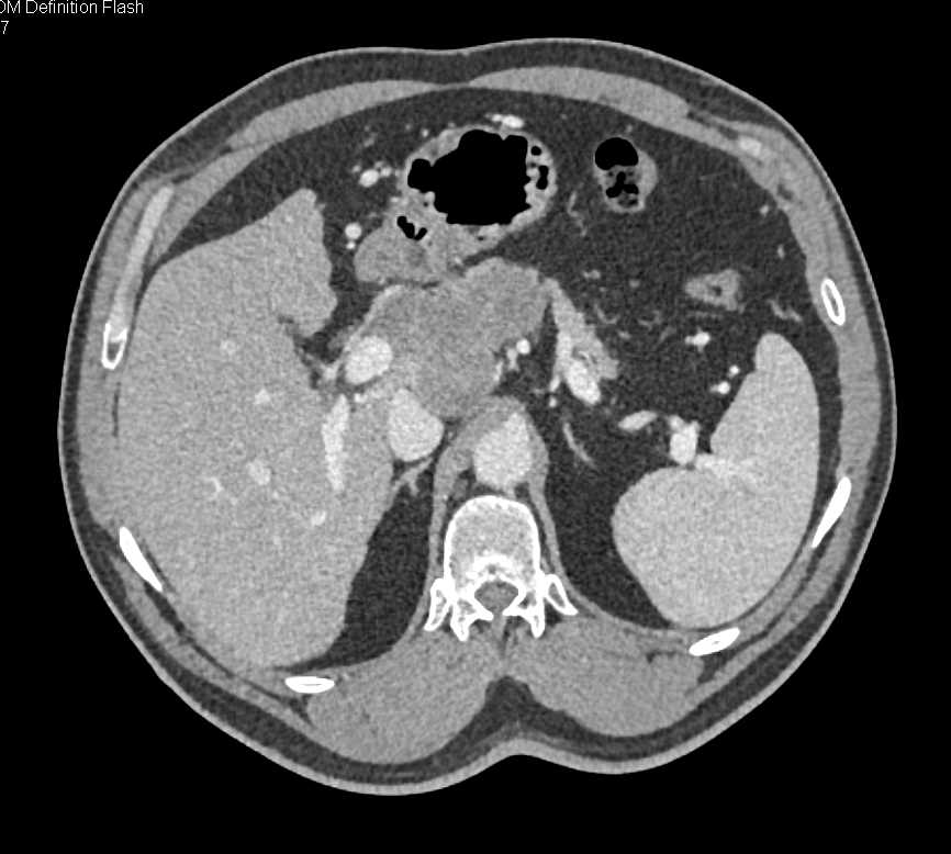 Serous Cystadenoma - CTisus CT Scan