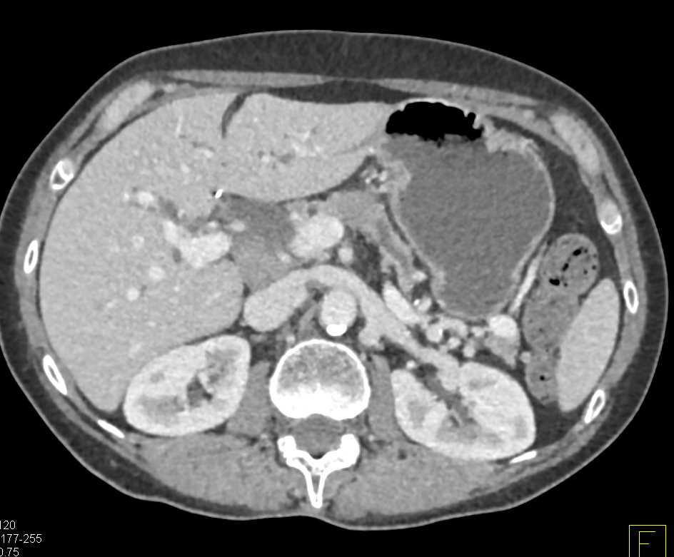 Pancreatic Adenocarcinoma - CTisus CT Scan