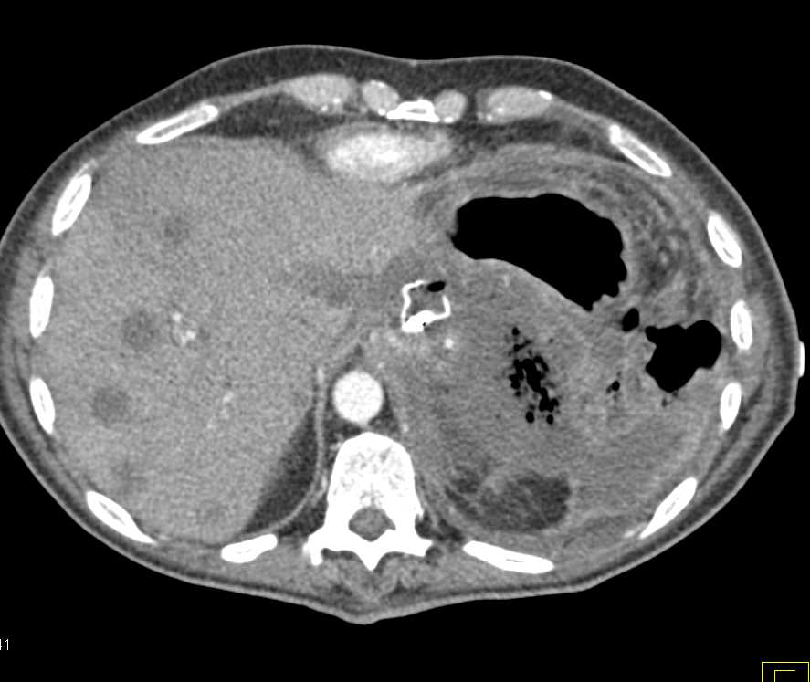 Pancreatic Cancer with Necrosis and Liver Metastases - CTisus CT Scan