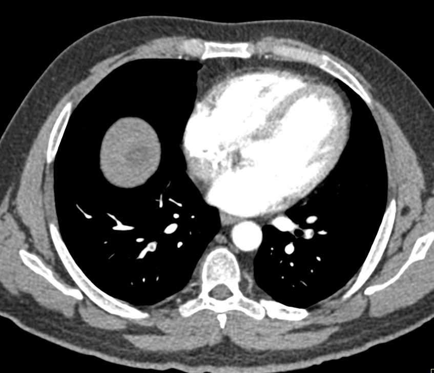 Pancreas Adenocarcinoma with Liver Metastases and Pulmonary Embolism - CTisus CT Scan